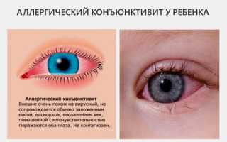 Определяем и лечим аллергический конъюнктивит у ребенка