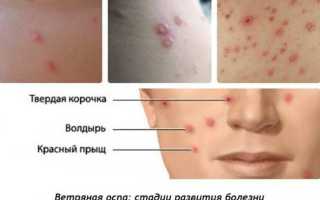 Чем лечат ветрянку у ребенка: медикаменты и народные способы