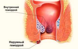 Эффективные методы лечения геморроя при беременности