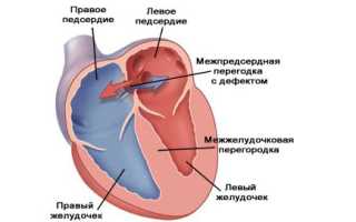 Врожденный порок сердца дефект межпредсердной перегородки