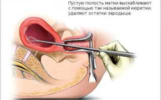 Сколько дней после выскабливания может болеть низ живота и поясница, почему кровит?