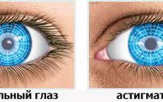 Симптомы, лечение и коррекция астигматизма у детей