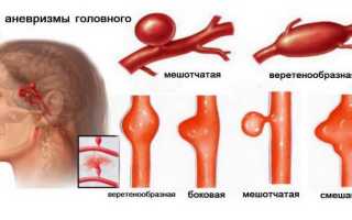 Последствия аневризмы: к чему готовиться пациентам после операции